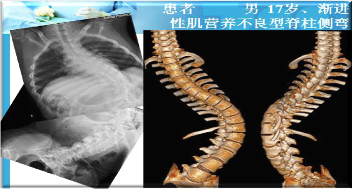 上海數造攜手安徽省二院骨三科專家章玉冰主任 開展3D打印醫(yī)療骨科應用在線講堂